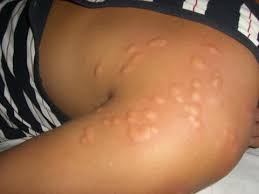 Progetto Bedbug